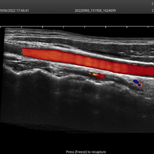20220906 174642 Vascular 263